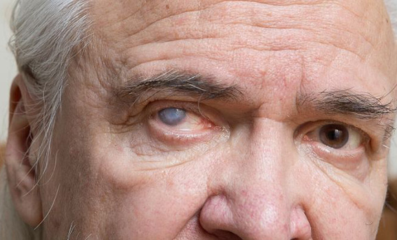 Cataract-Treatment-Torrance-CA-