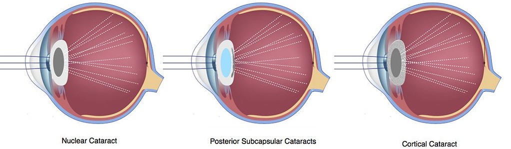 cataracts-treatment-South-Bay