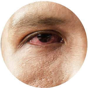 laser-treatment-for-glaucoma