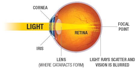what-is-the-best-treatment-for-cataracts
